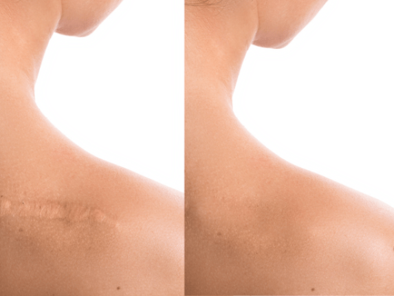 scars-min